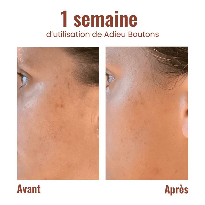 Addio brufoli - Roll-on anti-imperfezioni