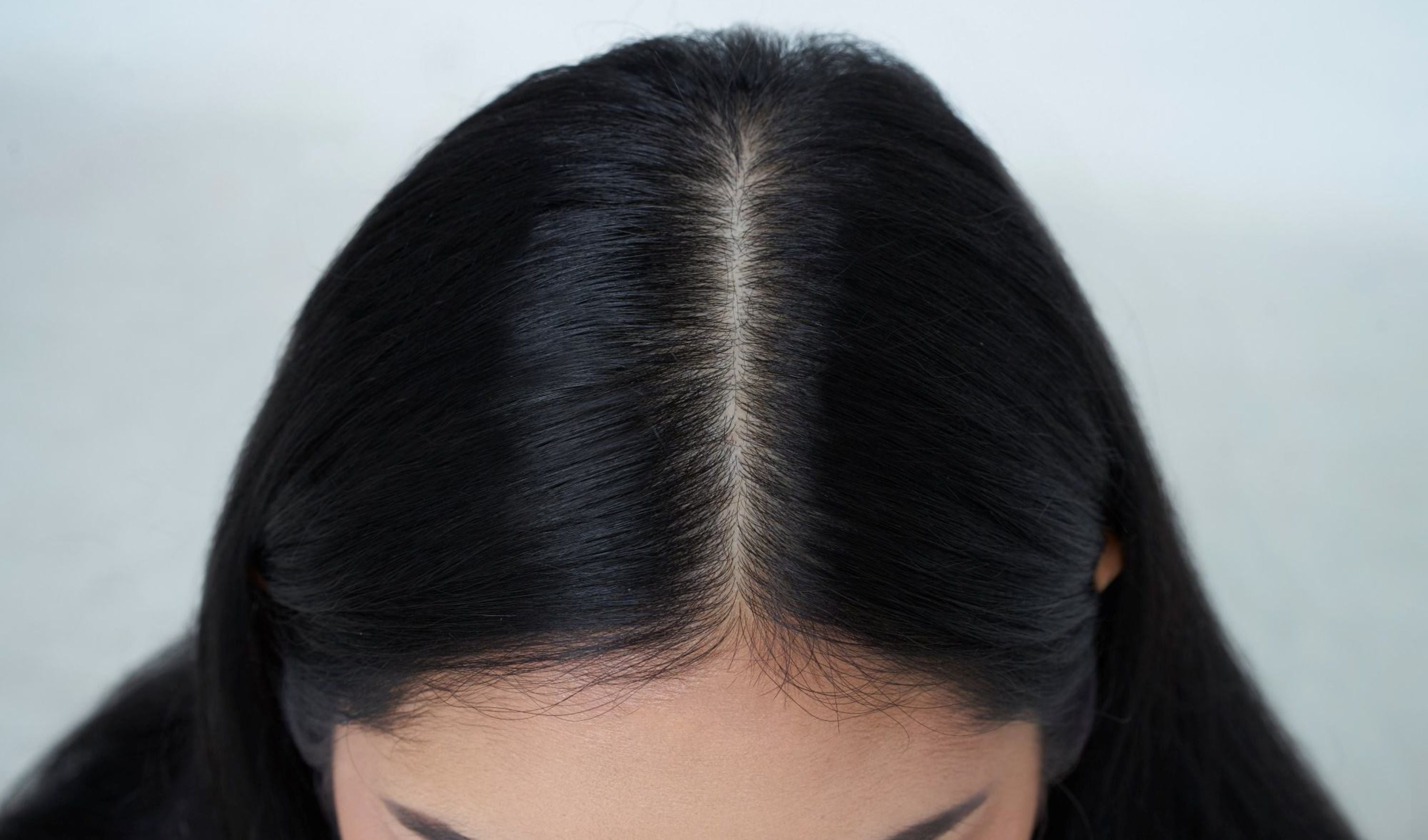 pellicules cheveux