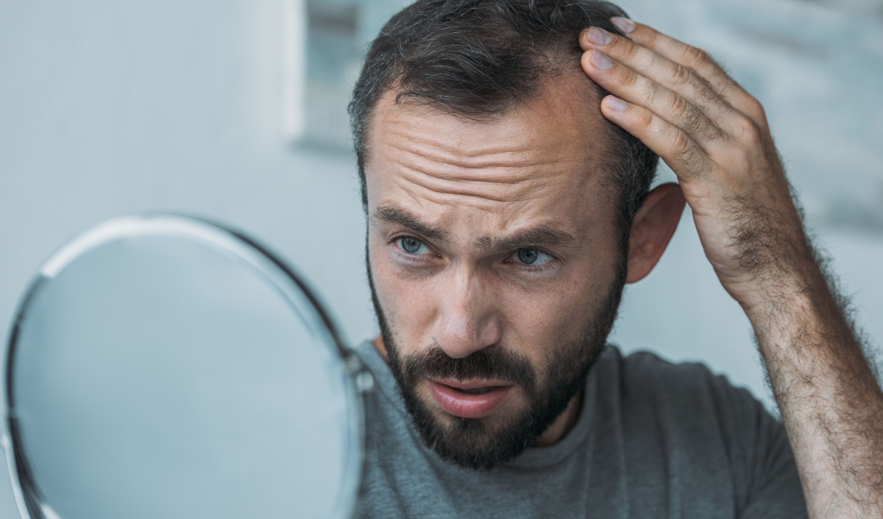 perte de cheveux homme