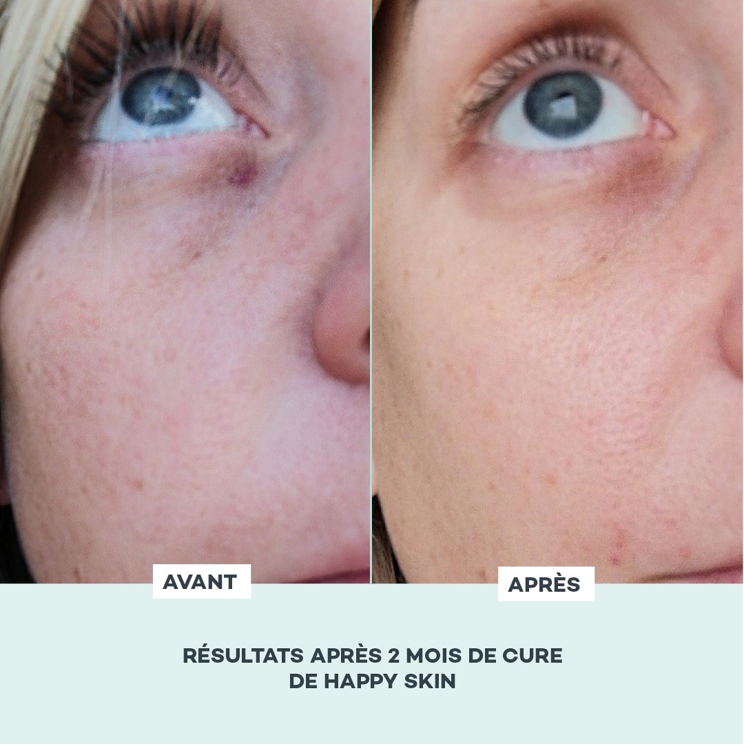 Gommose BELLE PEAU