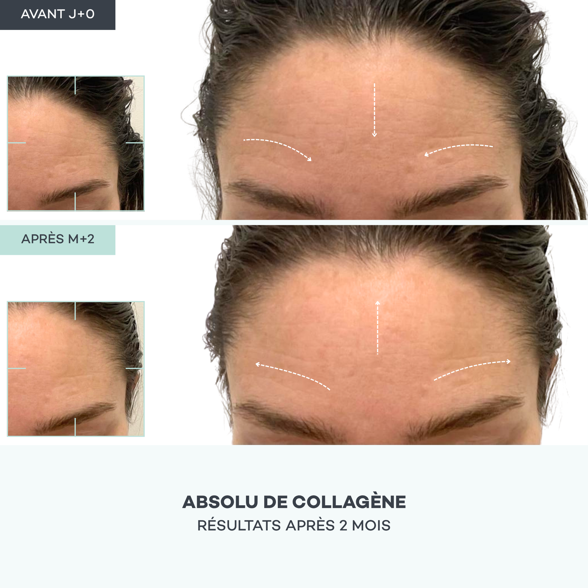 Assoluto di collagene
